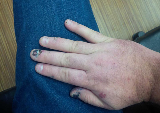 Stace Nelson's Battle Wound